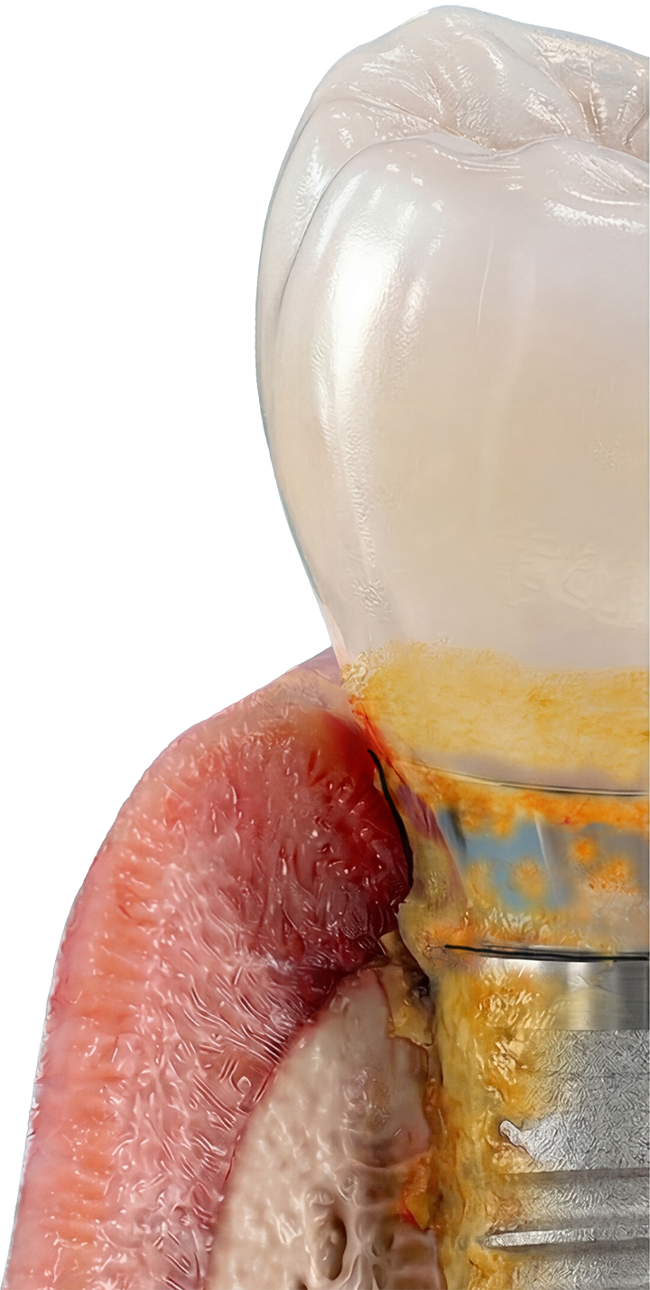 Diseased dental implant with plaque and bone loss